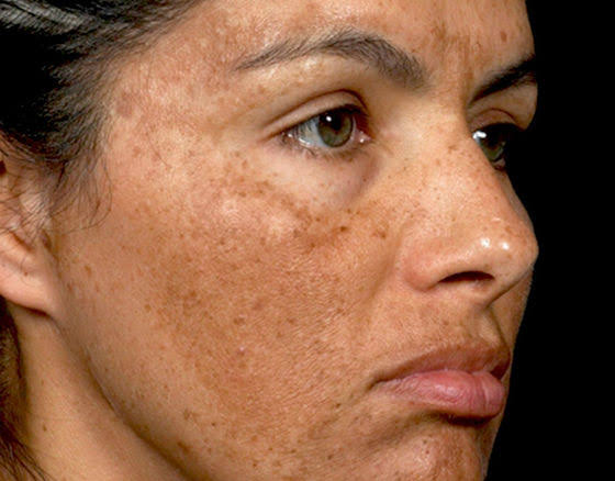 Pigmentation Treatment